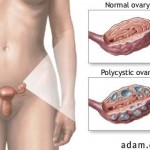 figure1 polycystic ovaries
